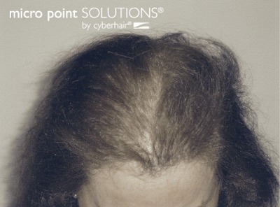 Hair Replacement Solutions