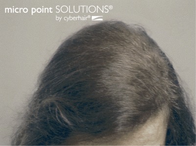 Hair Replacement Solutions